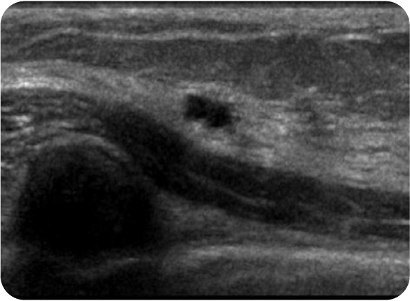 breast tissue under ultrasound